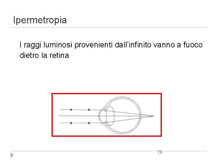 Ipermetropia I raggi luminosi provenienti dall’infinito vanno a fuoco dietro la retina 78 