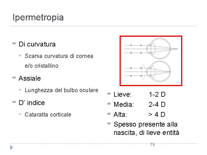 Ipermetropia Di curvatura Scarsa curvatura di cornea e/o cristallino Assiale Lunghezza del bulbo oculare