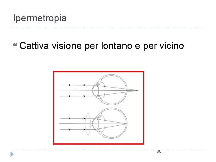 Ipermetropia Cattiva visione per lontano e per vicino 80 