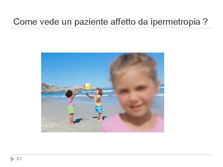 Come vede un paziente affetto da ipermetropia ? 81 Come vede un paziente affetto da ipermetropia ? 81