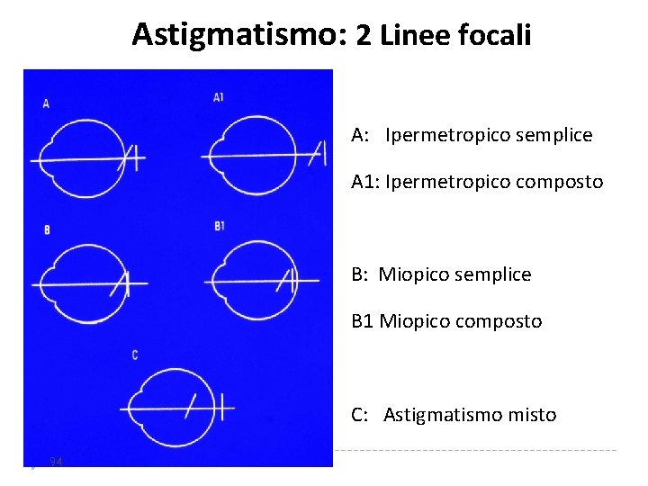 Astigmatismo: 2 Linee focali A: Ipermetropico semplice A 1: Ipermetropico composto B: Miopico semplice