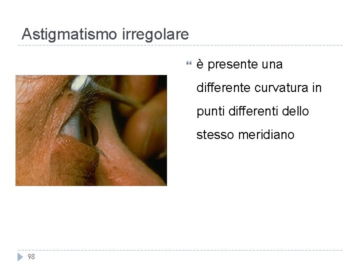 Astigmatismo irregolare è presente una differente curvatura in punti differenti dello stesso meridiano 98