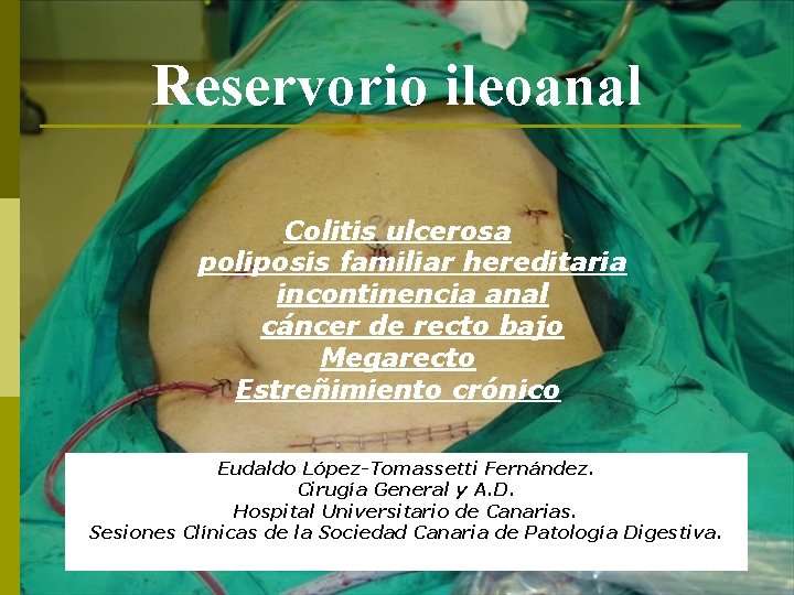 Reservorio ileoanal Colitis ulcerosa poliposis familiar hereditaria incontinencia anal cáncer de recto bajo Megarecto