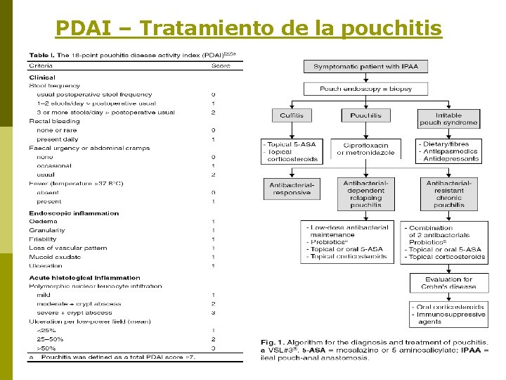 PDAI – Tratamiento de la pouchitis 