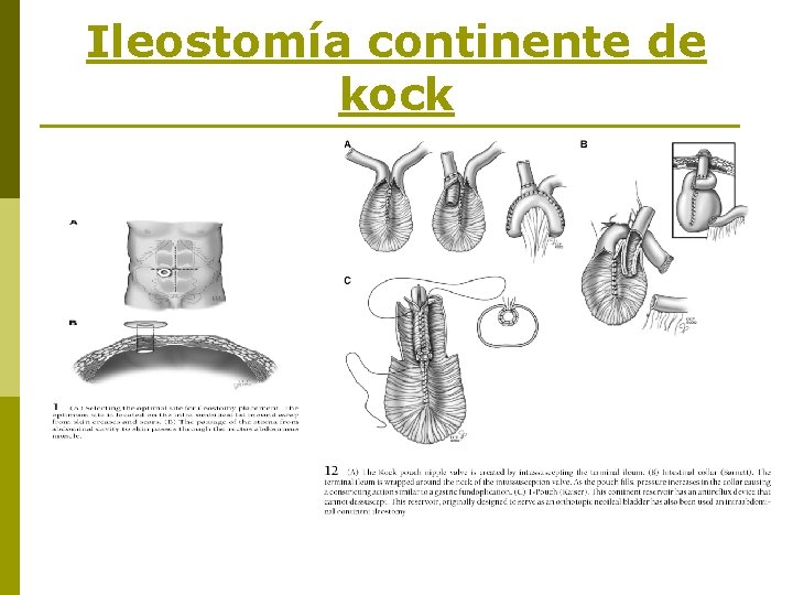 Ileostomía continente de kock 