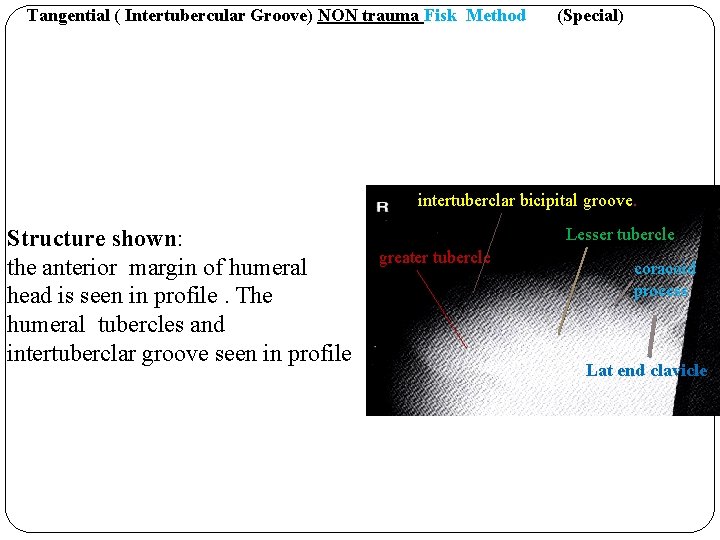 Tangential ( Intertubercular Groove) NON trauma Fisk Method (Special) intertuberclar bicipital groove. Structure shown: