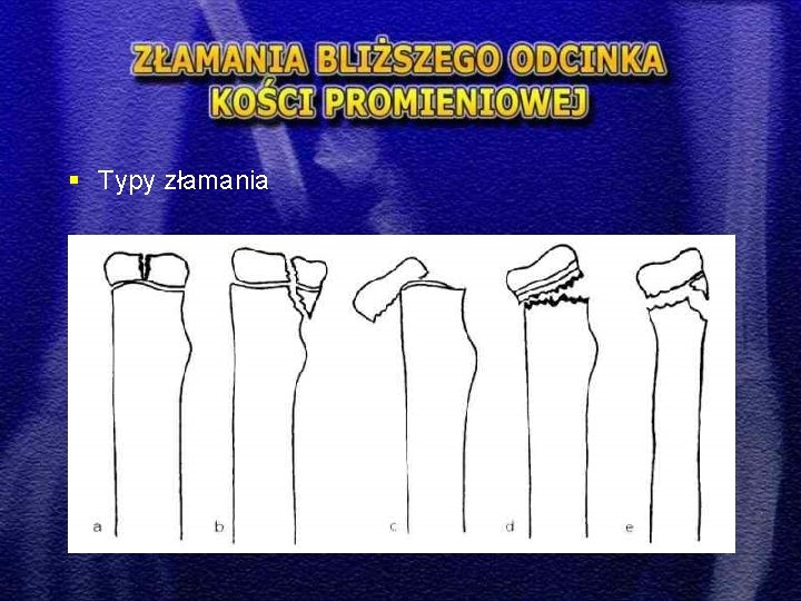 § Typy złamania 