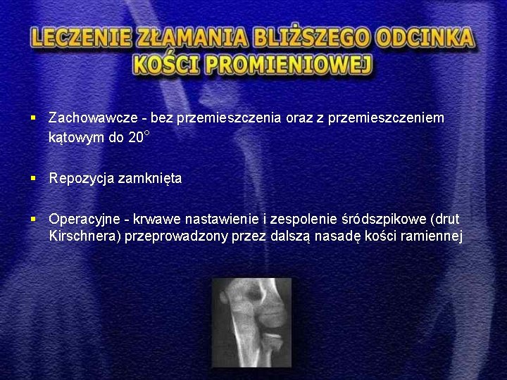 § Zachowawcze - bez przemieszczenia oraz z przemieszczeniem kątowym do 20° § Repozycja zamknięta