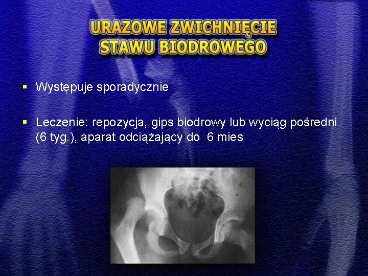 § Występuje sporadycznie § Leczenie: repozycja, gips biodrowy lub wyciąg pośredni (6 tyg. ),