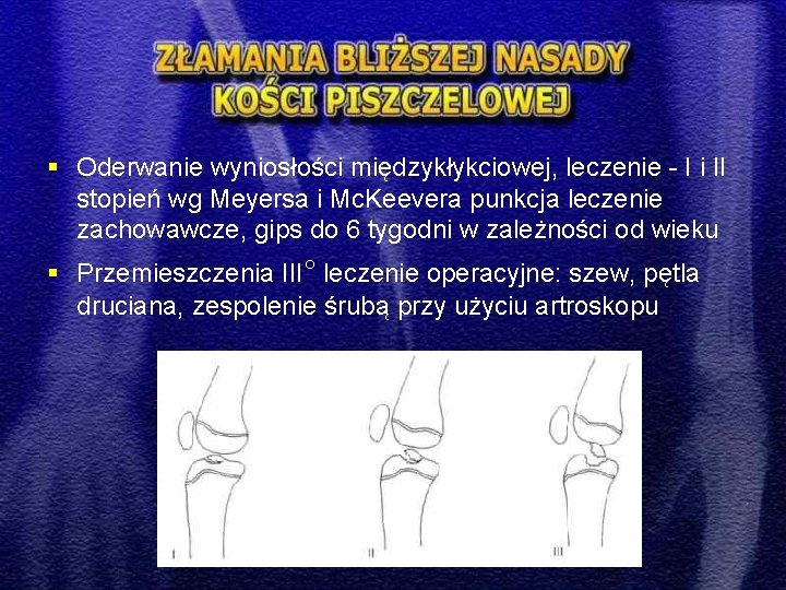 § Oderwanie wyniosłości międzykłykciowej, leczenie - I i II stopień wg Meyersa i Mc.