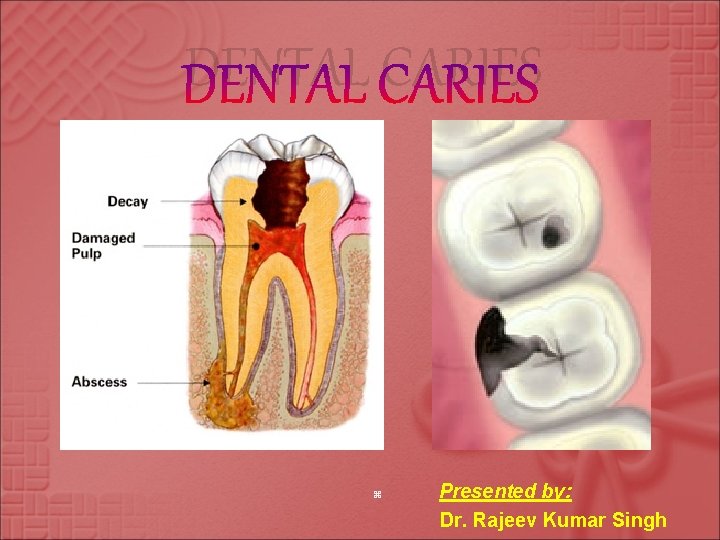 DENTAL CARIES z Presented by: Dr. Rajeev Kumar Singh 