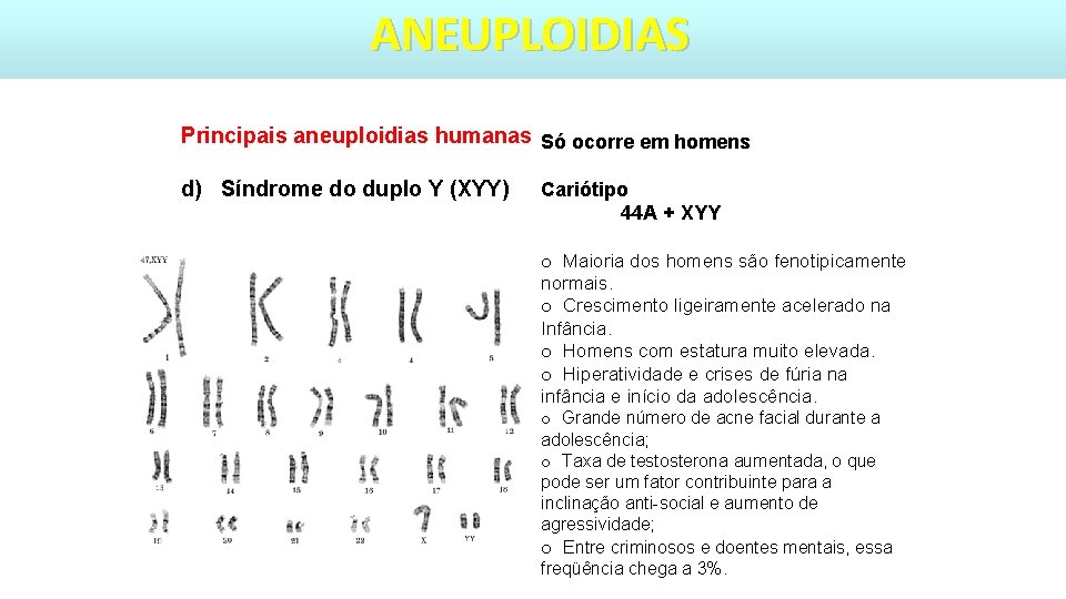 ANEUPLOIDIAS Principais aneuploidias humanas Só ocorre em homens d) Síndrome do duplo Y (XYY)