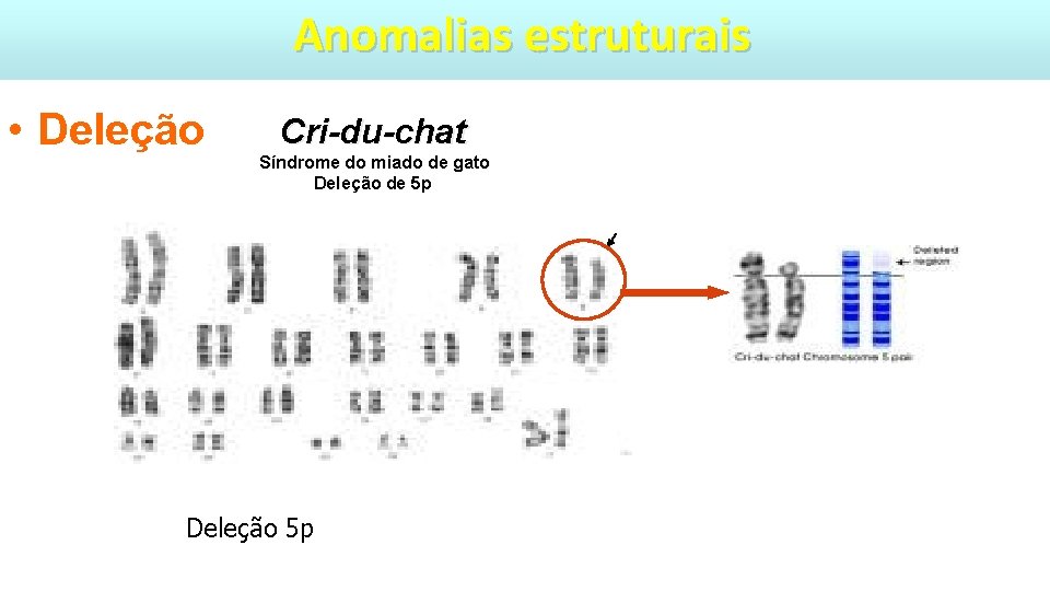 Anomalias estruturais • Deleção Cri-du-chat Síndrome do miado de gato Deleção de 5 p