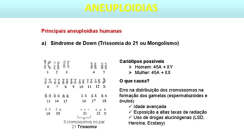ANEUPLOIDIAS Principais aneuploidias humanas a) Síndrome de Down (Trissomia do 21 ou Mongolismo) Cariótipos