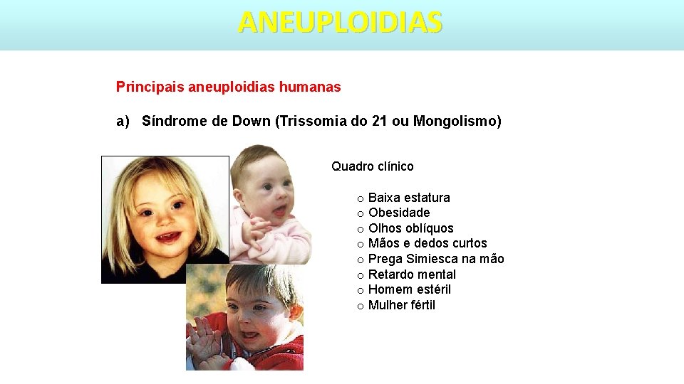 ANEUPLOIDIAS Principais aneuploidias humanas a) Síndrome de Down (Trissomia do 21 ou Mongolismo) Quadro