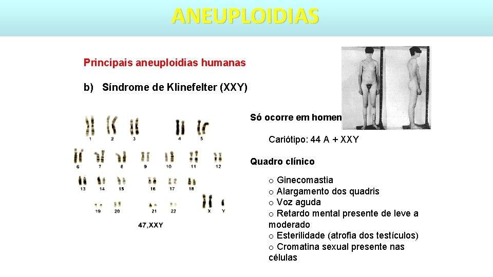 ANEUPLOIDIAS Principais aneuploidias humanas b) Síndrome de Klinefelter (XXY) Só ocorre em homens Cariótipo: