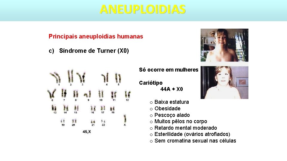 ANEUPLOIDIAS Principais aneuploidias humanas c) Síndrome de Turner (X 0) Só ocorre em mulheres