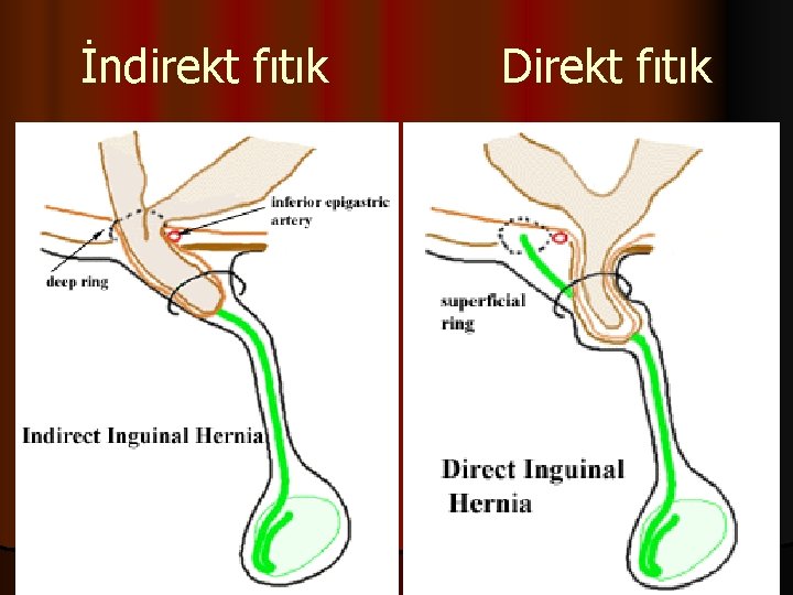 İndirekt fıtık Direkt fıtık 