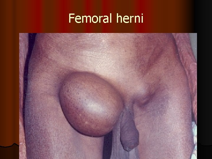 Femoral herni 