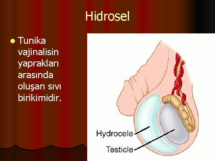 Hidrosel l Tunika vajinalisin yaprakları arasında oluşan sıvı birikimidir. 