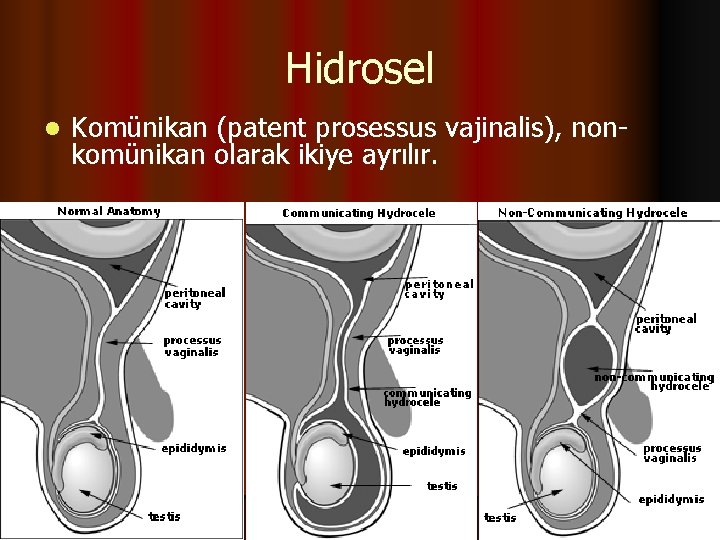Hidrosel l Komünikan (patent prosessus vajinalis), nonkomünikan olarak ikiye ayrılır. 