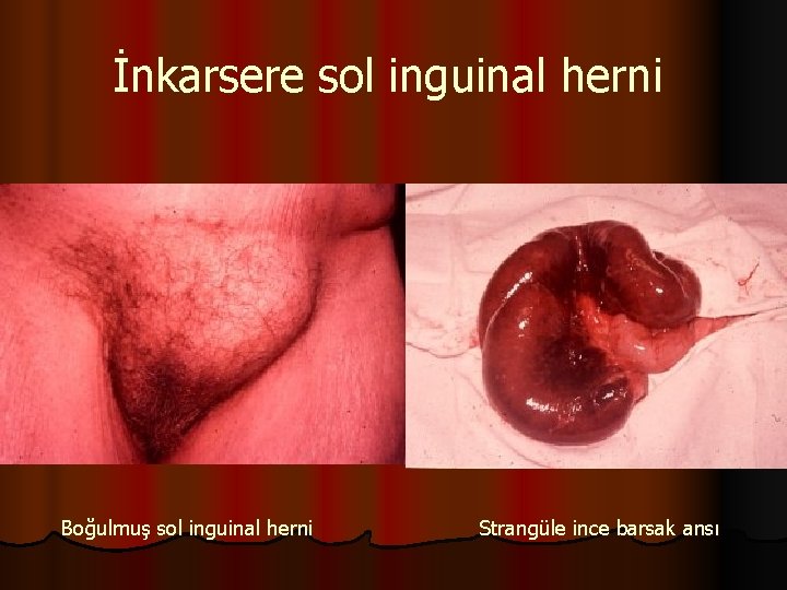 İnkarsere sol inguinal herni Boğulmuş sol inguinal herni Strangüle ince barsak ansı 