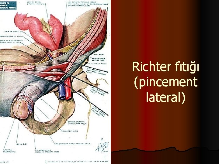 Richter fıtığı (pincement lateral) 