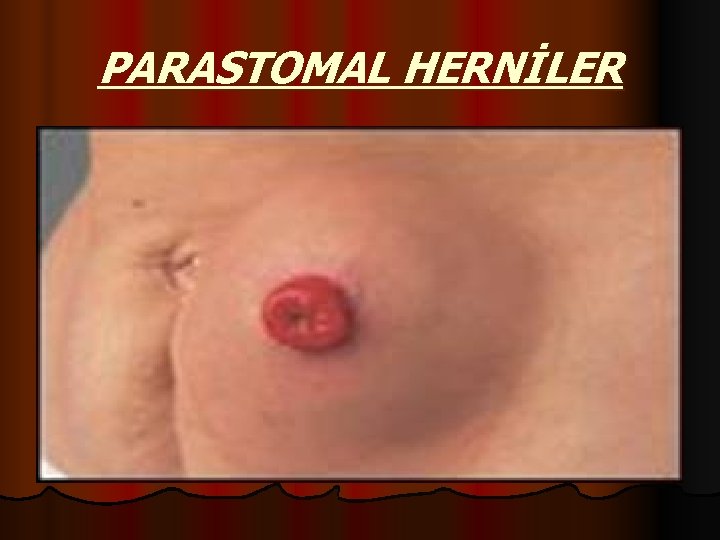 PARASTOMAL HERNİLER 