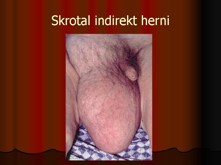 Skrotal indirekt herni 