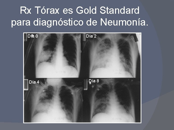 Rx Tórax es Gold Standard para diagnóstico de Neumonía. Día 0 Día 4 Día