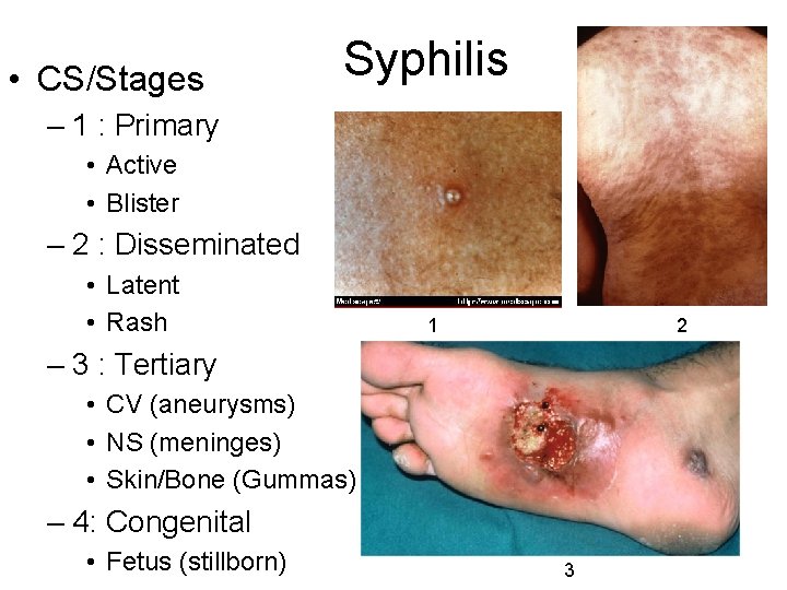  • CS/Stages Syphilis – 1 : Primary • Active • Blister – 2