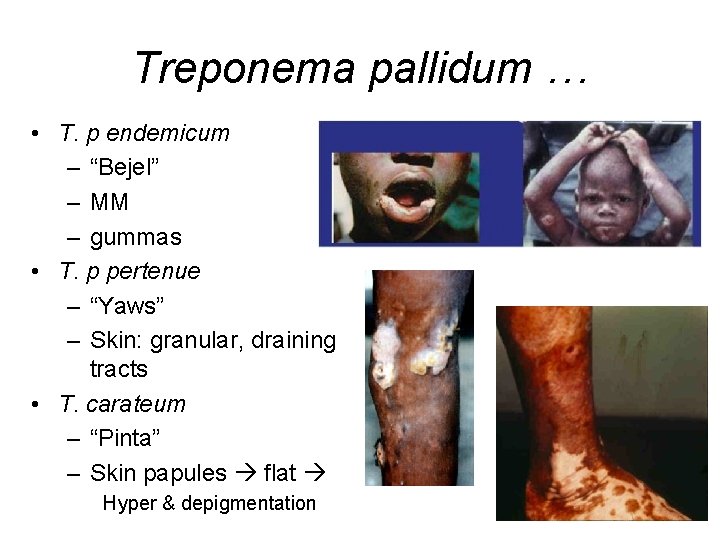 Treponema pallidum … • T. p endemicum – “Bejel” – MM – gummas •