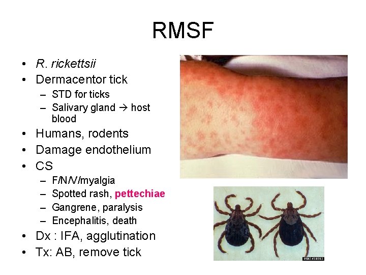 RMSF • R. rickettsii • Dermacentor tick – STD for ticks – Salivary gland