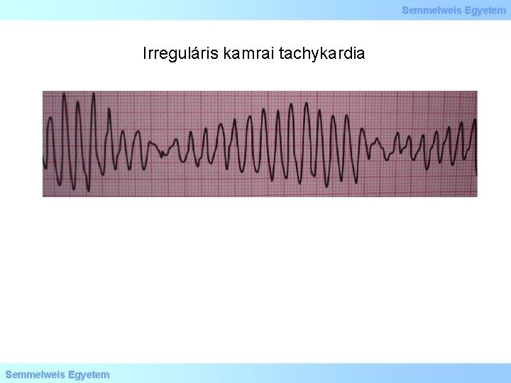 Irreguláris kamrai tachykardia Irreguláris kamrai tachykardia