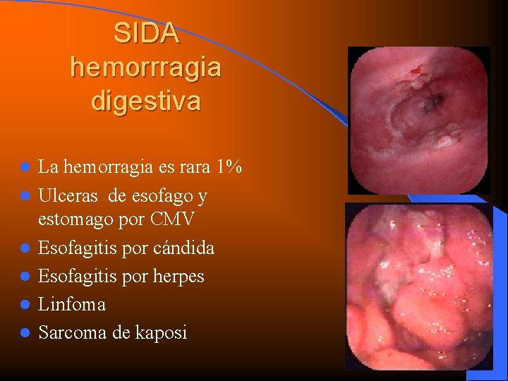 SIDA hemorrragia digestiva l l l La hemorragia es rara 1% Ulceras de esofago