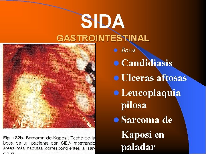 SIDA GASTROINTESTINAL l Boca l Candidiasis l Ulceras aftosas l Leucoplaquia pilosa l Sarcoma
