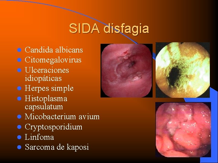 SIDA disfagia l l l l l Candida albicans Citomegalovirus Ulceraciones idiopáticas Herpes simple