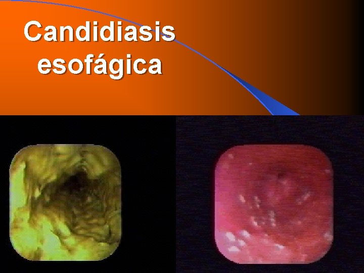 Candidiasis esofágica 
