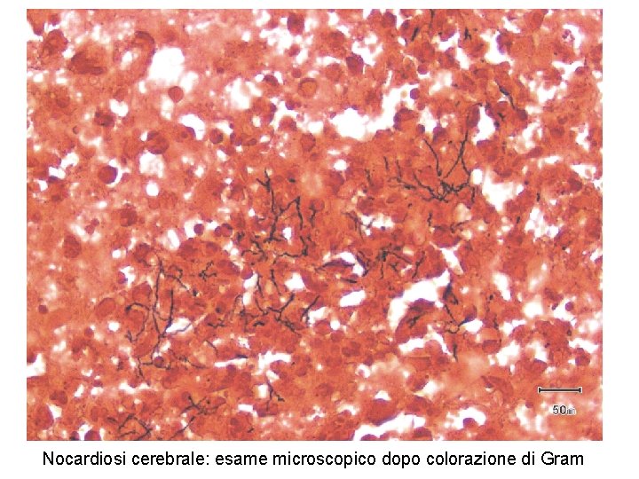Nocardiosi cerebrale: esame microscopico dopo colorazione di Gram 