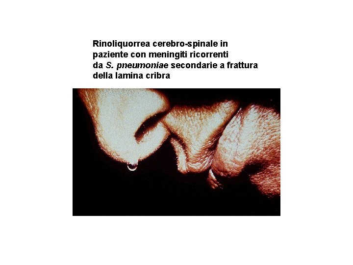 Rinoliquorrea cerebro-spinale in paziente con meningiti ricorrenti da S. pneumoniae secondarie a frattura della