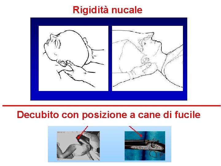 Rigidità nucale Decubito con posizione a cane di fucile 