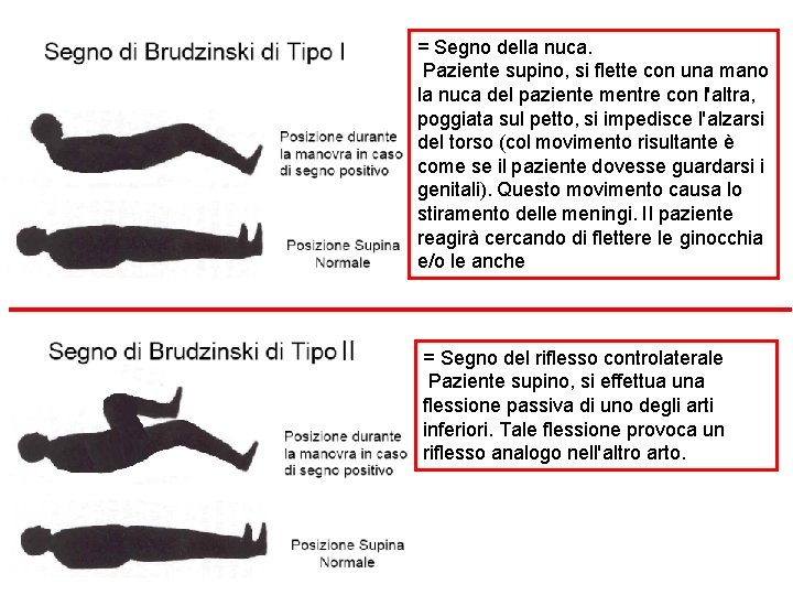 = Segno della nuca. Paziente supino, si flette con una mano la nuca del