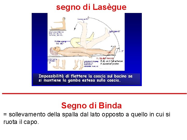 segno di Lasègue Segno di Binda = sollevamento della spalla dal lato opposto a