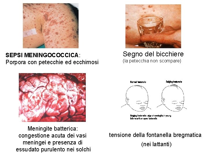 SEPSI MENINGOCOCCICA: Porpora con petecchie ed ecchimosi Meningite batterica: congestione acuta dei vasi meningei