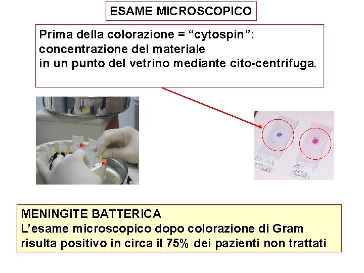 ESAME MICROSCOPICO Prima della colorazione = “cytospin”: concentrazione del materiale in un punto del