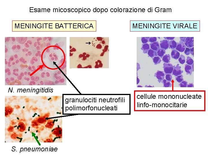 Esame micoscopico dopo colorazione di Gram MENINGITE BATTERICA N. meningitidis granulociti neutrofili polimorfonucleati S.