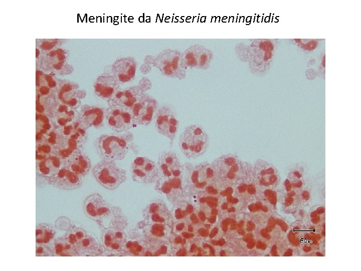Meningite da Neisseria meningitidis 