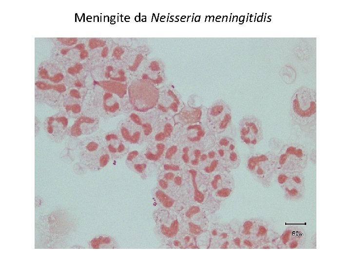 Meningite da Neisseria meningitidis 