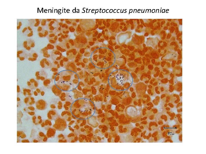 Meningite da Streptococcus pneumoniae 