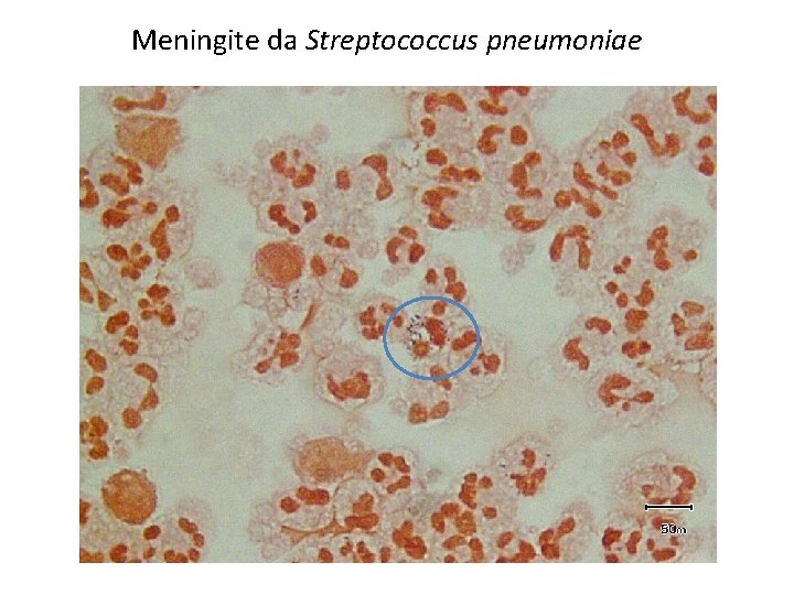 Meningite da Streptococcus pneumoniae 
